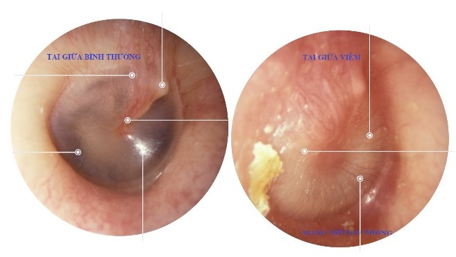 Viêm tai giữa ở trẻ em: Chưa khỏi hay bị tái nhiễm?